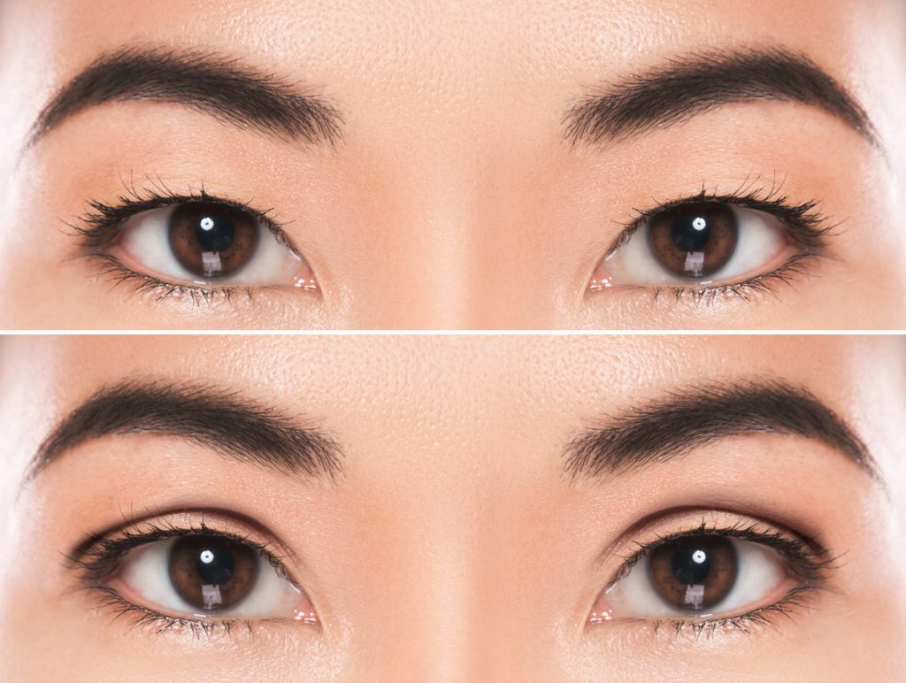 Image of Before & After Asian Eyelid Surgery