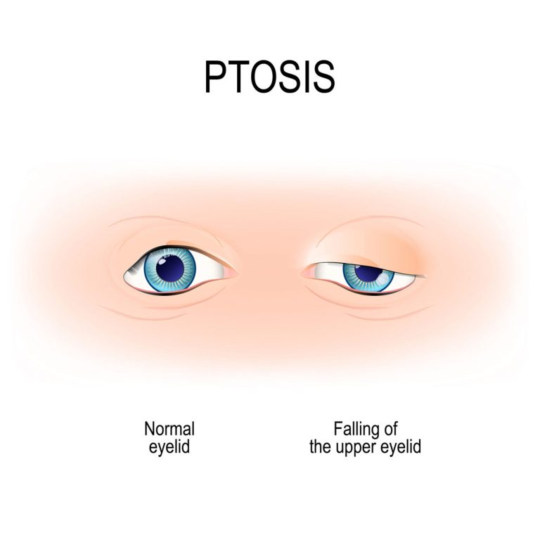 Ptosis-Drawing of normal eyelid vs. falling of the upper eyelid blocking vision