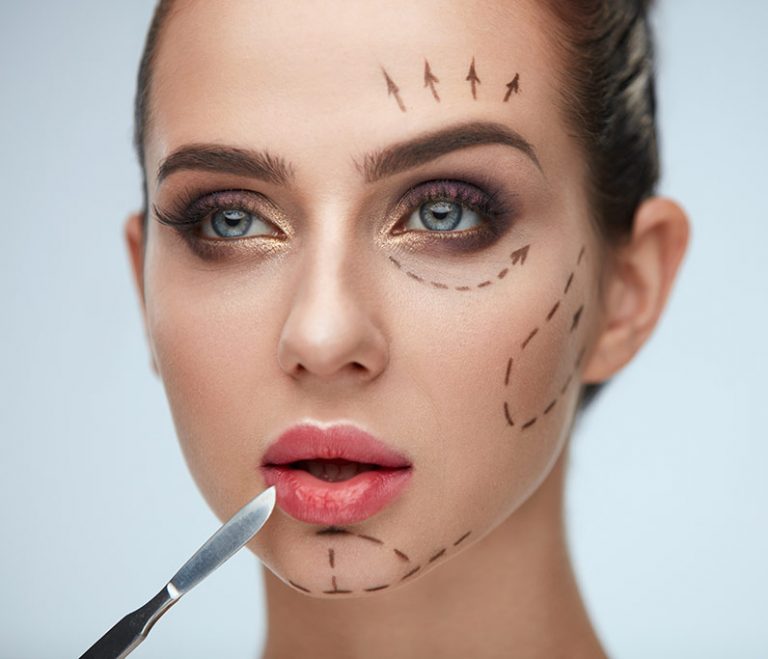 Photo of woman showing pre-treatment markings of face for Blepharoplasty procedure