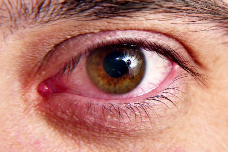 Dry Eye Syndrome - Eye Image