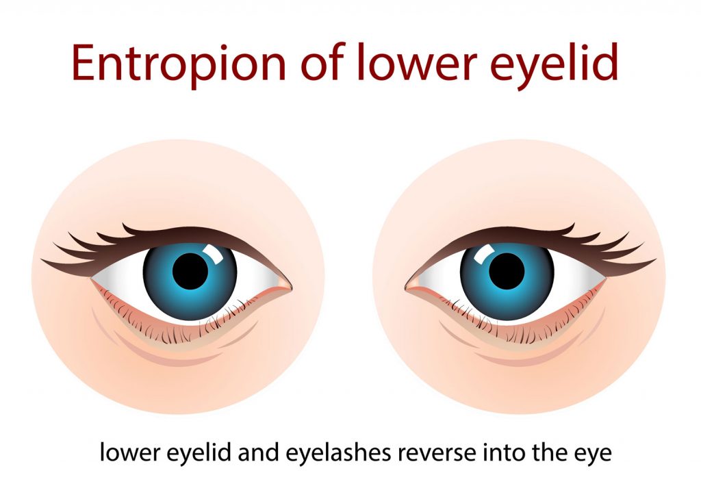 Entropion of the Lower Eyelid - Drawing Image