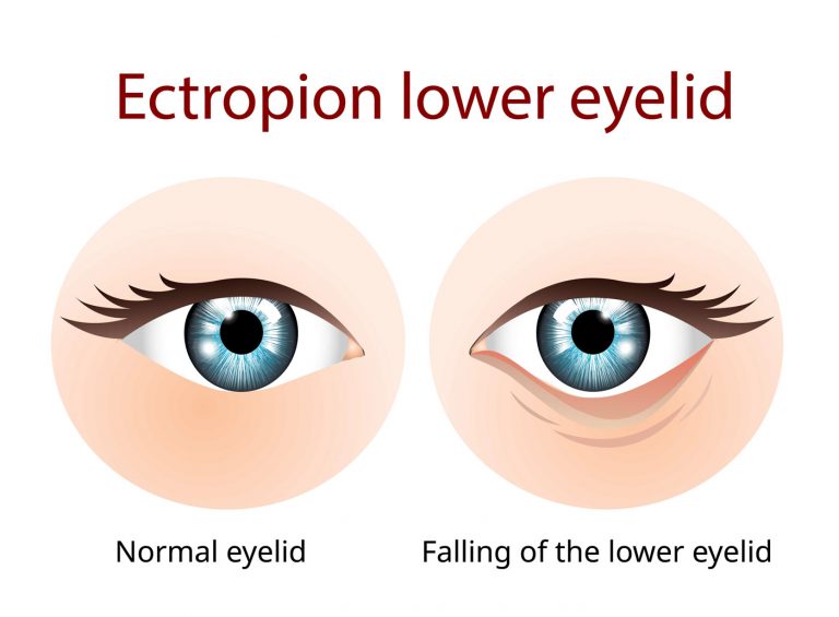 Ectropion on the Lower Eyelid - Drawing Image