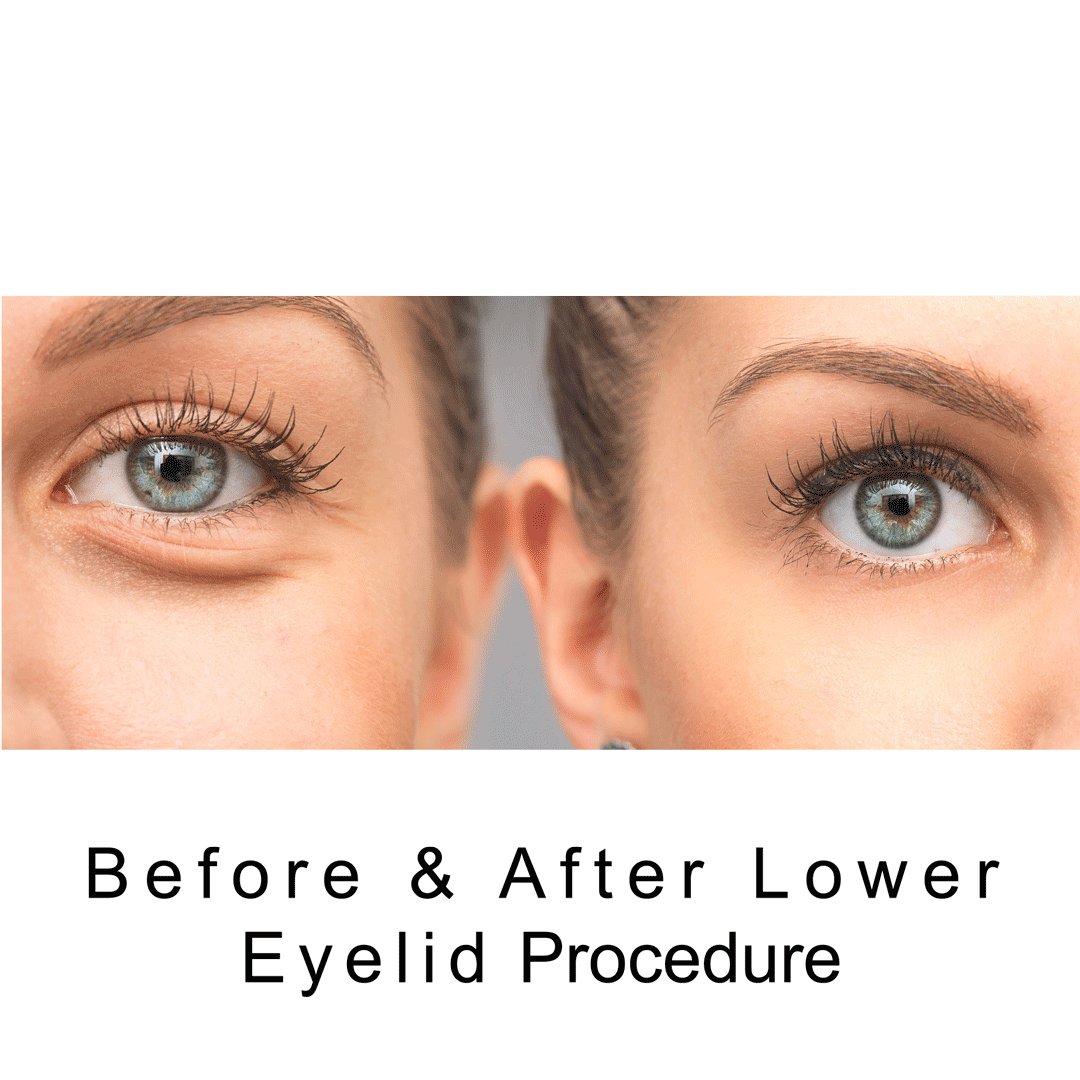 Before and After Image of a Lower Eyelid Procedure