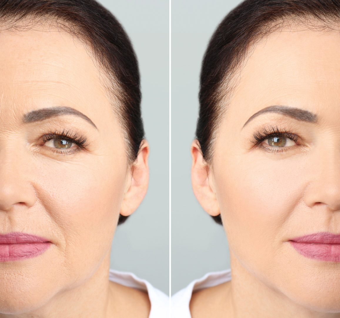 Before & After Blepharoplasty Upper & Lower Eyelid Procedure