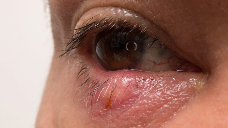 Skin Cancer on the Eyelid Image